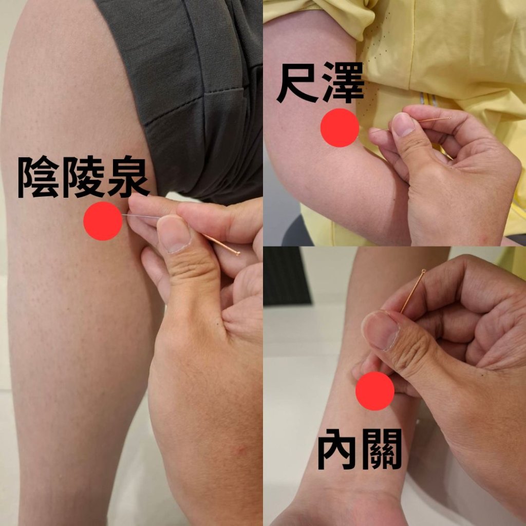 手指「喀」一下小心扳機指    中醫針灸助大幅改善