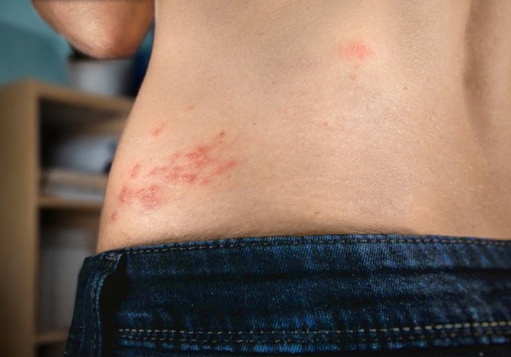 季節交替帶狀皰疹好發　中西醫整合治療提升免疫力成關鍵