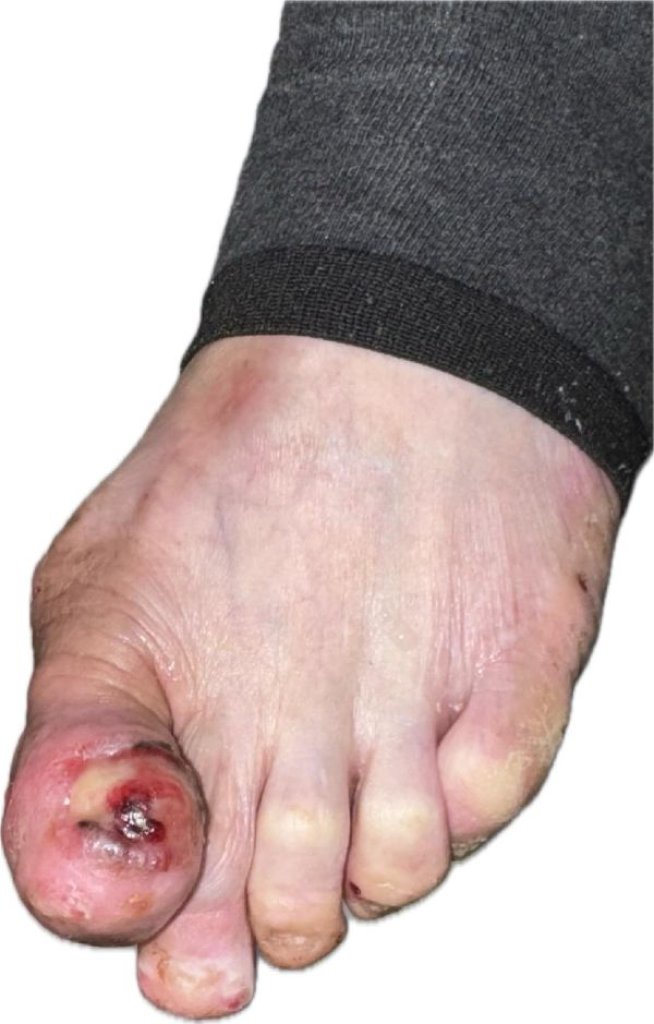 誤以為是甲溝炎竟藏「皮膚癌之冠」高醫整外精準揪出「惡性黑色素瘤」 跨團隊守護化解致命危機