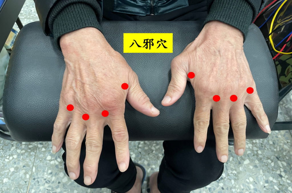 拿水杯都痛！6旬翁罹類風溼性關節炎   中醫針灸助擺脫止痛針