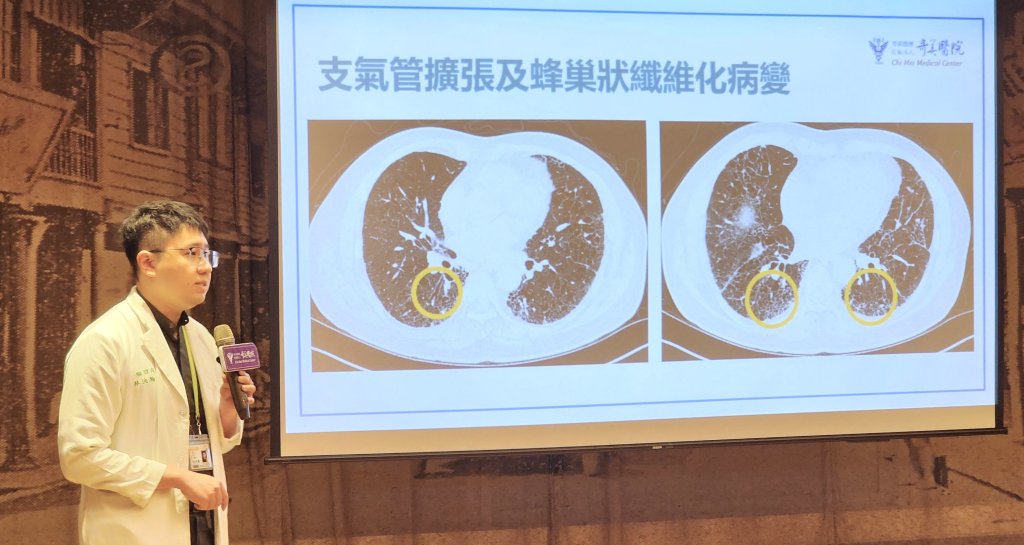 肺纖維化非絕症！奇美醫院多管齊下治療，讓硬化肺部「踩煞車」