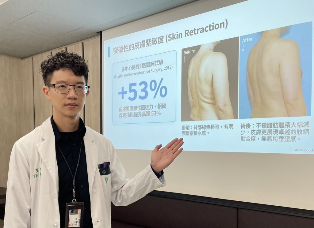 妙齡女努力健身小腹贅肉還是「如影隨形」？ 「威塑超音波氣泡脂雕系統」助找回腰線